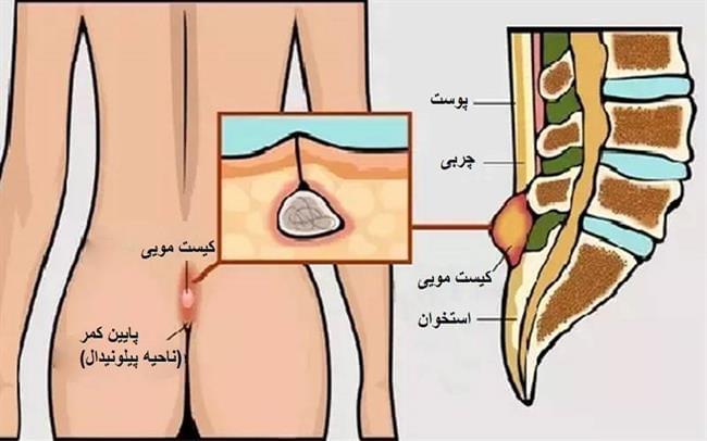 لیزر بهترین درمان بواسیر(هموروئید)، شقاق، فیستول و کیست مویی