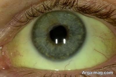 علت زردی چشم و شناخت علایم آن
