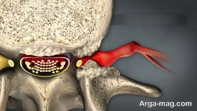 علائم و نشانه های تنگی کانال نخاعی