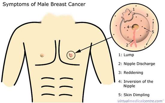 نشانه‌های سرطان سینه در آقایان