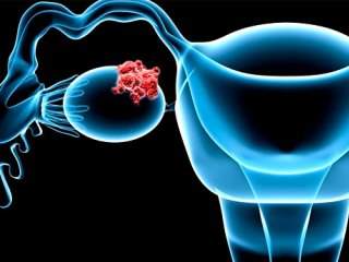علائم مبهم سرطان تخمدان
