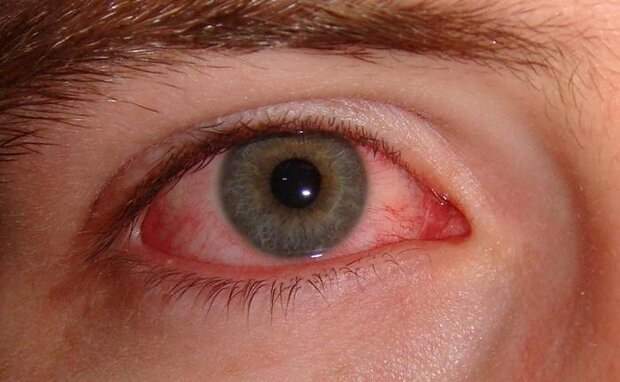 عارضه «چشم صورتی» علامت بیماری کرونا است؟ +عکس