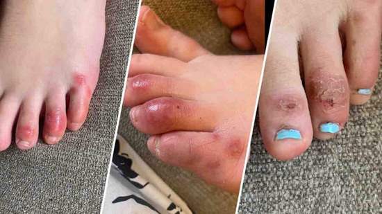 انگشت پای کوویدی، آخرین و عجیب‌ترین علامت آلودگی به ویروس کرونا