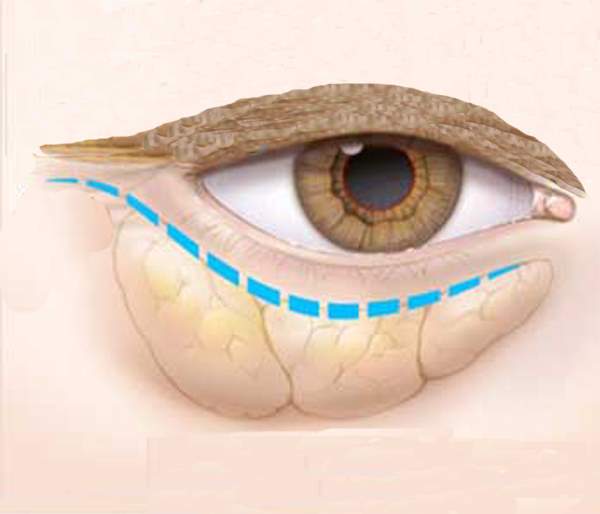 کیسه زیر چشم چیست و چگونه درمان می‌شود؟