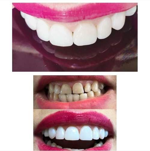 کامپوزیت دندان بهتر است یا لمینت سرامیکی؟