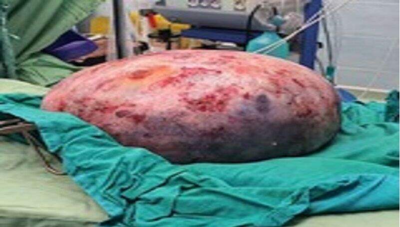 توده 9 کیلوگرمی از شکم یک بیمار در یاسوج خارج شد