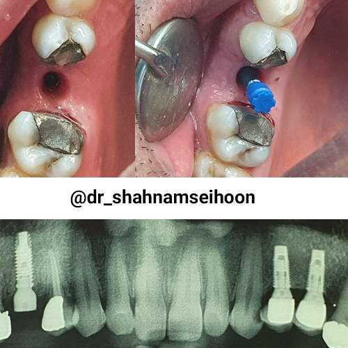 ایمپلنت بدون درد و استرس به روش دیجیتال بدون جراحی