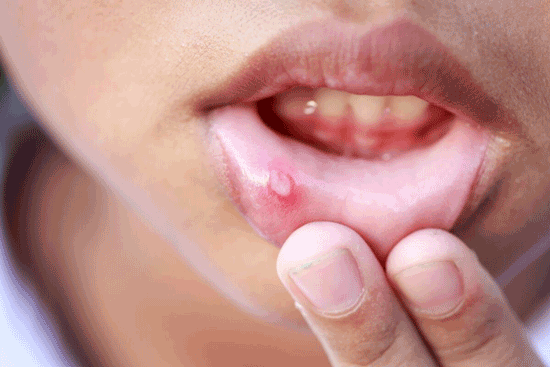 درمان‌های خانگی برای درمان آفت دهان