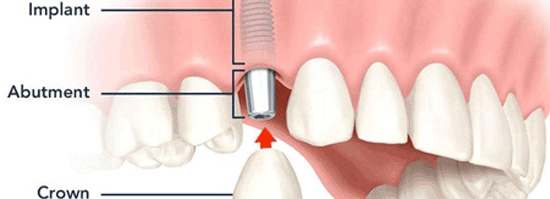 اصلاح طرح لبخند