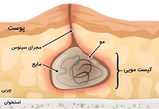 علائم، علل و راه‌های درمان کیست مویی