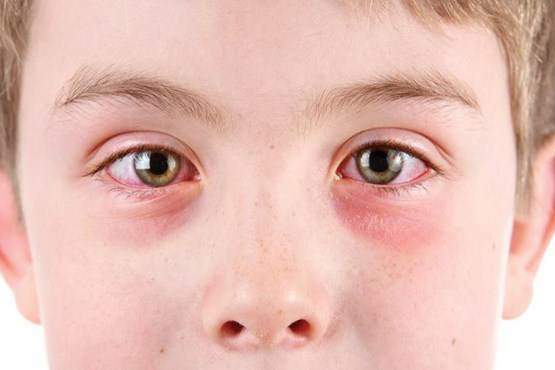 سندروم چشمان خسته، تهدیدی برای کودکان