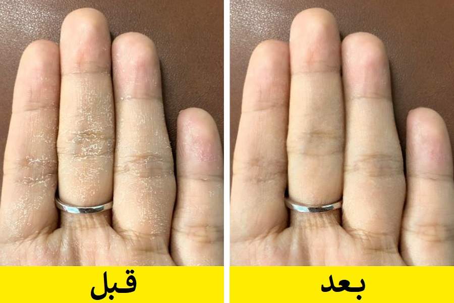 چند ترفند ساده و طبیعی برای رفع خشکی دست ها