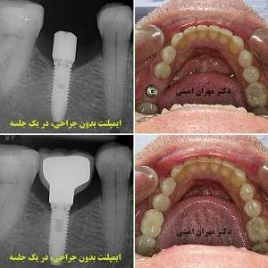 قیمت ایمپلنت - دکتر مهران امینی