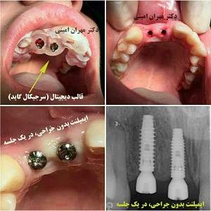 قیمت ایمپلنت - دکتر مهران امینی