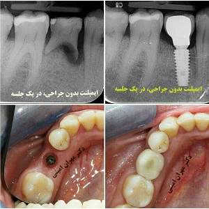 قیمت ایمپلنت - دکتر مهران امینی