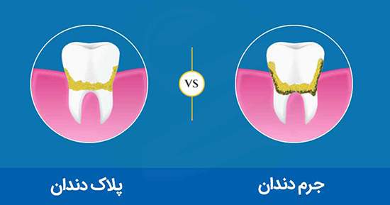 روش‌های از بین بردن پلاک دندان و جرم گیری دندان