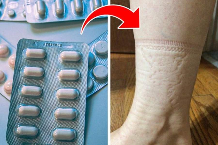 چرا جای کش جوراب روی پا می ماند؟