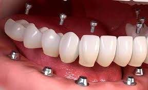 رازهای زیبایی با ایمپلنت دندان