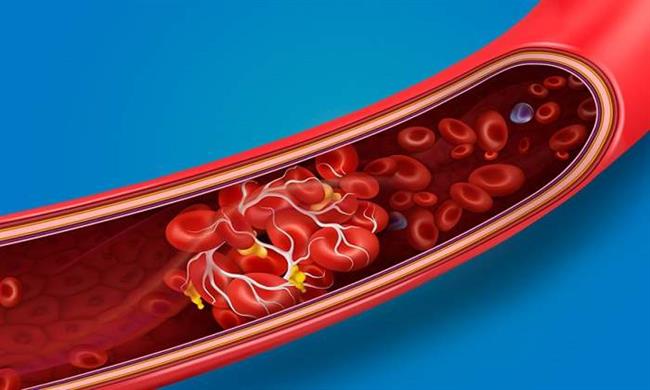 دلایل و عوامل خطر برای لخته‌های خون