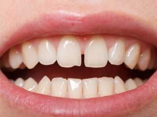 بستن فاصله میان دندان‌ها؛ بهترین روش کدام است؟