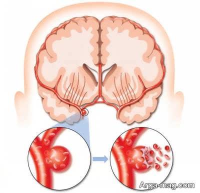 علایم و نشانه سکته مغزی هموراژیک