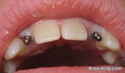 ایمپلنت دندان به صورت مرحله به مرحله