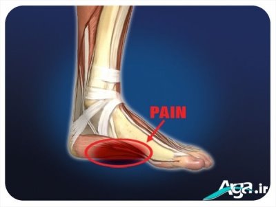 علت درد کف پا چیست؟ و برای درمان آن چه کنیم؟