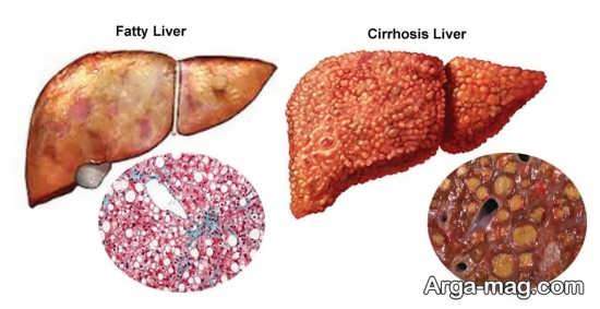 نشانه ها و علایم کبد چرب گرید 2