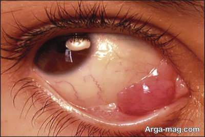 بررسی علل سرطان چشم