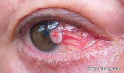 علایم سرطان چشم