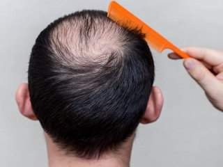 راهکارهایی برای پر پشتی موی آقایان