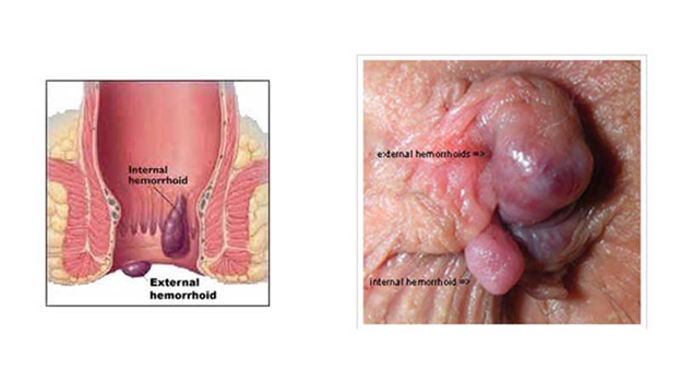روش های درمان هموروئید خارجی را بهتر بشناسید ؛ بواسیر خارجی
