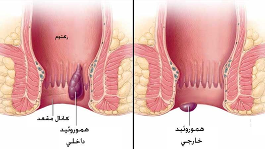 روش های درمان هموروئید خارجی را بهتر بشناسید ؛ بواسیر خارجی