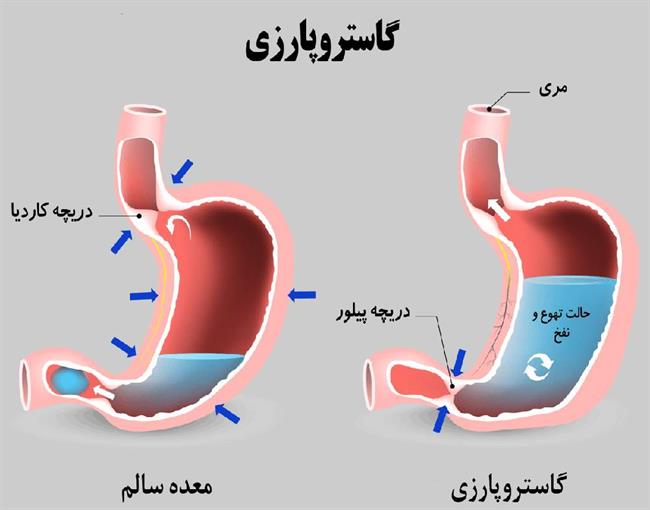 وقتی معده فلج می‌شود؛ از علائم تا درمان