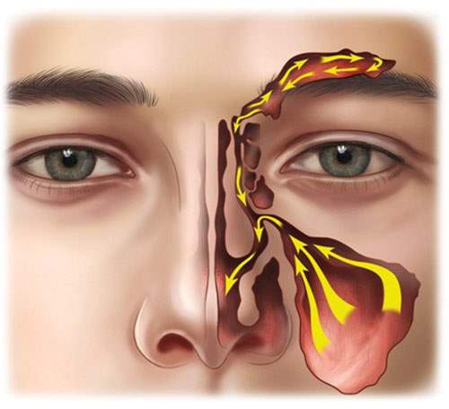 رنگ مخاط بینی و شرایط سلامت شما