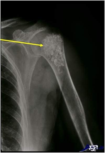 علائم سرطان استخوان و نشانه های ابتلا به آن