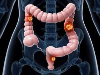 خوراکی‌هایی که از سرطان روده پیشگیری می‌کند