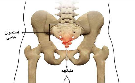 درد استخوان دنبالچه