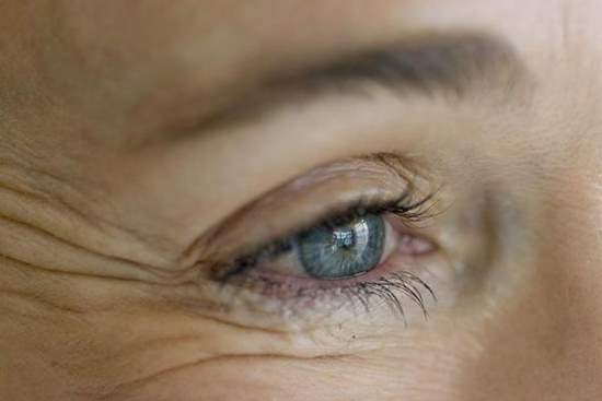 درمان خطوط پنجه کلاغی اطراف چشم
