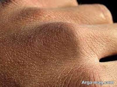 علل خشکه زدن پوست دست ها 