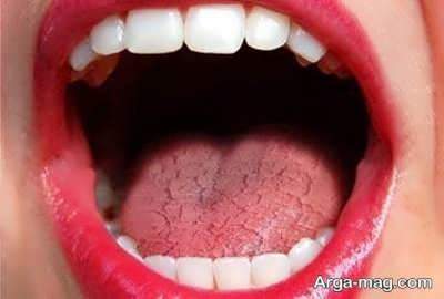 علت خشکی دهان و روشهای رفع آن