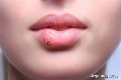 انواع پماد تبخال