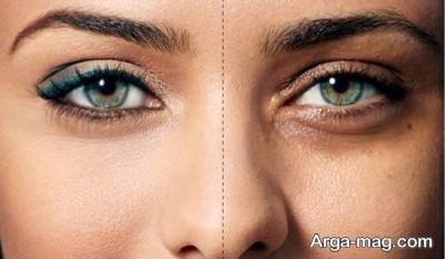 درمان سیاهی دور چشم با رزماری 