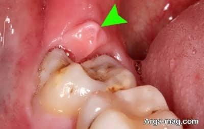 آشنایی با عوارض جراحی دندان عقل