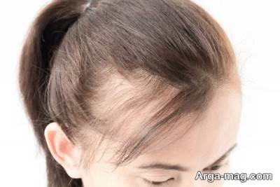 برای درمان ریزش مو باید از غذا های ضد التهاب استفاده کنید.