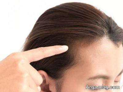 استفادهاز غذا های کلسیم دار ریزش مو هورمونی را کنترل می کند.