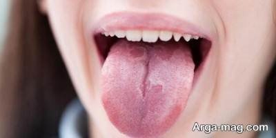 انواع سرطان زبان 
