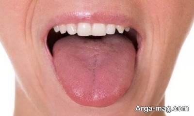 درمان سرطان زبان 