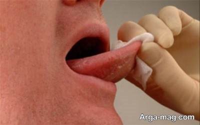 پیشگیری از سرطان دهان و زبان 