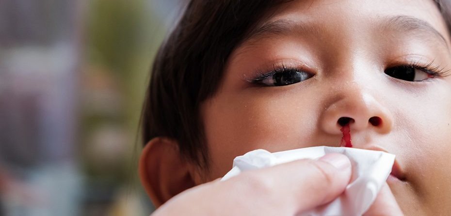 علت خونریزی بینی در کودکان و روش‌های درمان آن